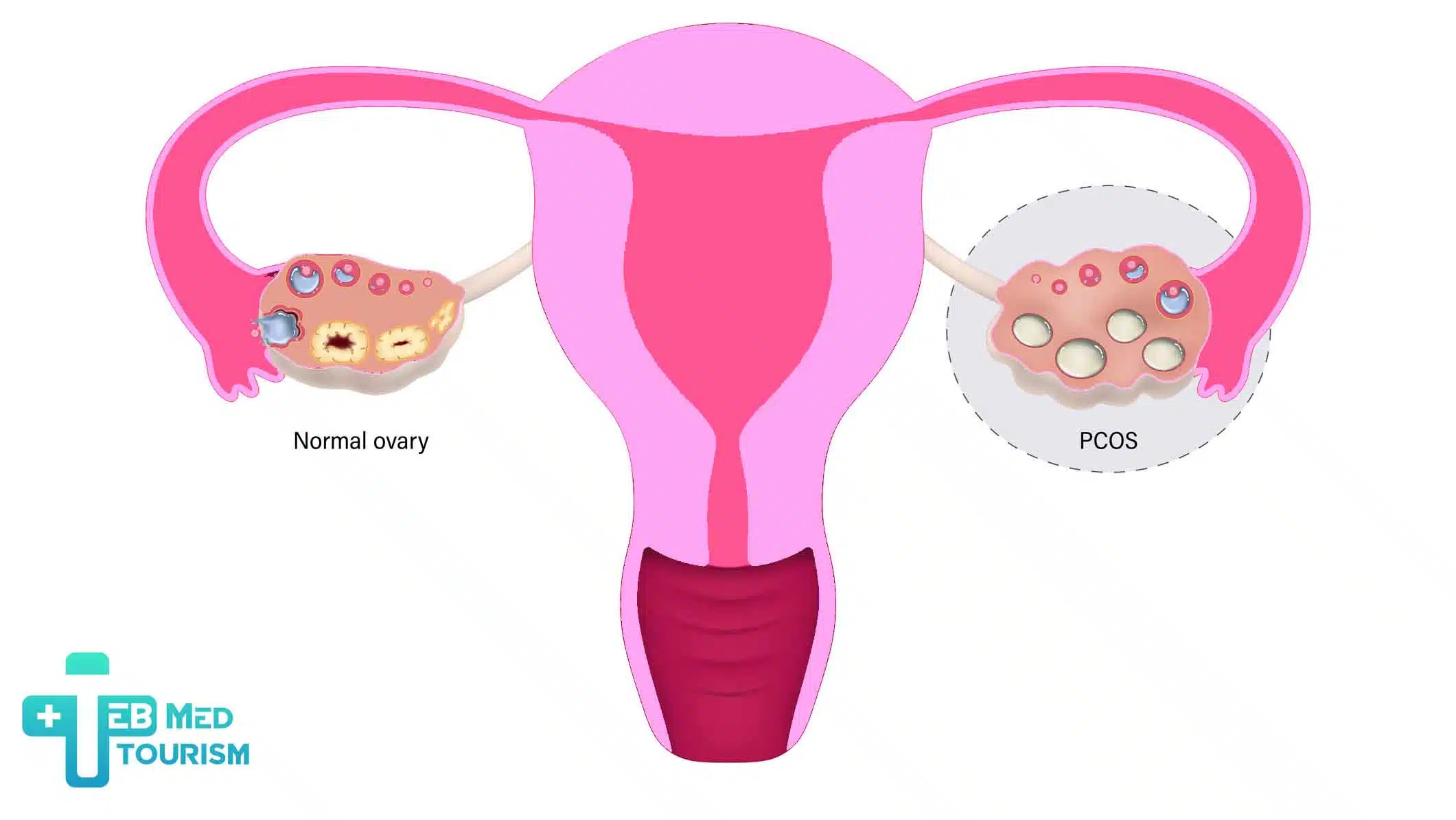 pcos-2